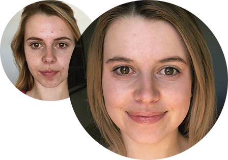 maniac Augment Paragraaf Skin Purifying Mask (3oz) | Proactiv® Products